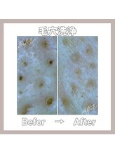 マヴィ 守口店(MavY.)/スコープで毛穴の様子見れます♪
