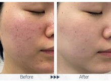 リレイスフクオカ(RelaceFUKUOKA)/グロウパールピーリング