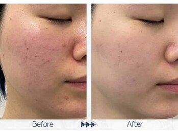 リレイスフクオカ(RelaceFUKUOKA)/グロウパールピーリング