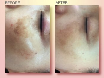 ジュリア オージェ 京橋店/ ビフォーアフター(シミケア)