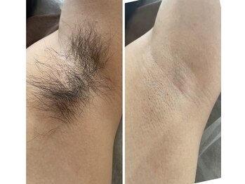 アールセカンド(R.Second)/全身脱毛! 都度払いOK!