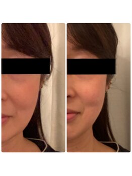 ジョルジオ東京/脂肪分解成分導入