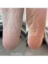 フットミー(foot mii)/足のガサガサ