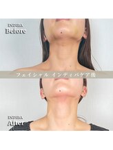 術後の女神 大阪本町店/ダウンタイムケア・インディバ