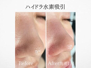 アンドミルル(and Milulu)/【ハイドラ水素吸引】
