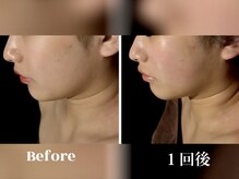 エフプラネット(F Planet)/フェイシャルエステ+全身リンパ