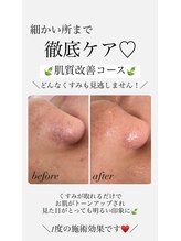 リーミー(Re:me)/★肌質改善コース★