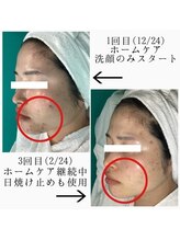 ヴィヴ 熊本(ViV)/セルマントリートメント