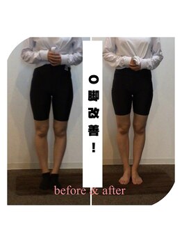 スタイルラボ高松/O脚矯正の効果♪