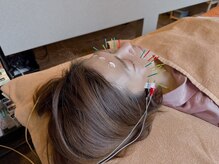 鍼灸整骨ミヤビ 札幌八軒(鍼灸整骨MIYABI)/電気を流すプルプル美容鍼★