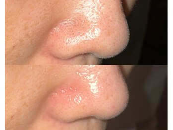 ル シーニュ/毛穴エクストラクション