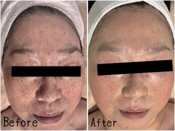 レイズ(RAISE)/当店人気No.1 水光ピーリング