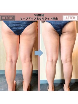 マーリエ(Malie)/【ラフォス】脚＆セルライト