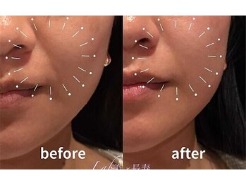 ラブ美長寿 沖縄本店(Lab)/ビフォーアフター光フェイシャル