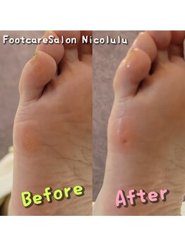 ニコルル 大阪天満店(Nicolulu)/繰り返す魚の目ビフォーアフター