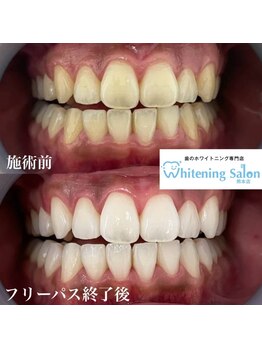 ホワイトニングサロン 熊本店/人気のセルフホワイトニンング