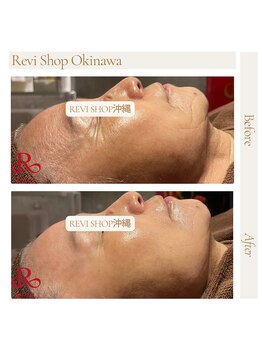 ルヴィショップ 沖縄(REVI SHOP)/セットでキレイさアップ