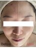 【次世代ハーブピーリング】肌質改善×角質ケア◎REVI陶肌トリートメント