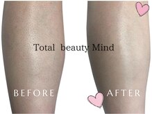 トータルビューティー マインド(Total Beauty)/３箇所脱毛