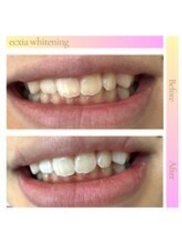 エクシアホワイトニング 西宮北口店/ホワイトニングビフォーアフター