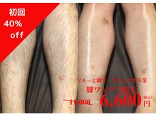 メンズ エステティック ヒーロー(men's esthetic HERO)