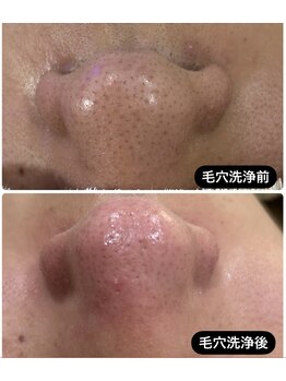 アバティック(ABatick)/毛穴の黒ずみ・皮脂・毛穴洗浄