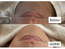 シュカ(Shuka)の雰囲気(脱毛器導入!脱毛しながら美肌になれるマシン!THR脱毛!)