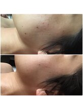 トータルビューティサロン リボーテ(Re:Beaute)/スポットシミケア