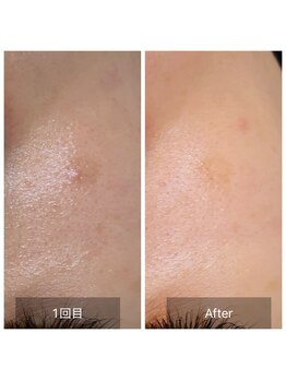 ビビ(VIVI)/くすみ・シミも改善