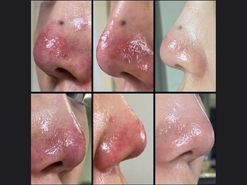 キュライム 熊本(CURAIM)/美肌管理 【30代女性】