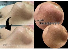ラウラボ バイ ウォーヴォ(RAW LAB by UOVO)の雰囲気（【メンズ毛穴洗浄】たった1回の施術で頑固な黒ずみもスッキリ！）