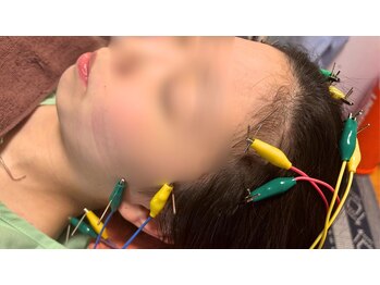 フラット柏(FLAT柏)の写真/頭のコリも顔のたるみも一気に解決！？お顔と頭皮の美容鍼×ヘッドスパ♪感動のスッキリ感を今すぐ体験♪