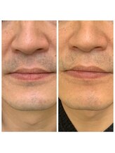 ビューティー サロン アイビー(Ivy)/ひげ脱毛