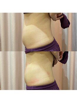 ミミー ヒロサキ(MiMiy HIROSAKI)/APTS Before After