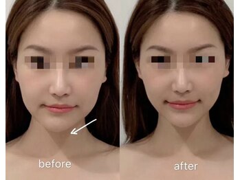 オプレア 千種店(OPREA)/【比較写真】小顔コルギ