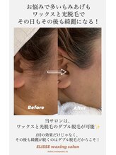 エリス(ELISSE)/ワックスと光脱毛のダブル脱毛