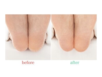 ティンク 札幌駅前店(Tink)/★夏のフット角質ケア★