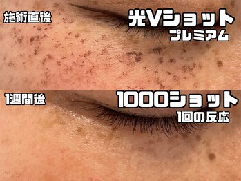 ヴィオール 名古屋栄店(VIOR)/光フェイシャル　プレミアム