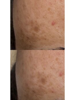 リノ(Lino)/シミケア1回施術