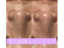 レアマカナ(LeaMakana)/毛穴洗浄＋ピーリング