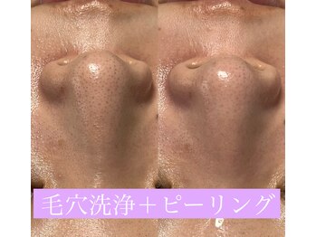 レアマカナ(LeaMakana)/毛穴洗浄+ピーリング