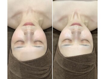 エスアール アミティ(SR Amity)/左Before／右After 