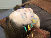 リベルタ鍼灸整骨院 新宿院(Liberta鍼灸整骨院)/化粧ノリが変わる！美肌美容鍼