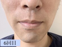 リース(Lys)/同じ脱毛機の直営店の実例