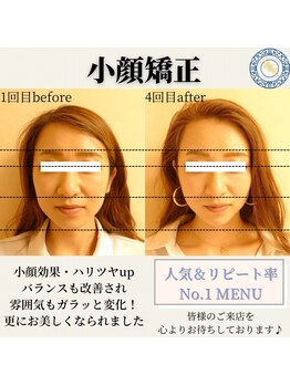 RKY/小顔矯正&頭蓋骨矯正4回(20代)