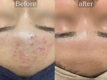 ホーミー(Homie)/ニキビ改善、赤みニキビ改善