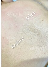 ビーラボ(Be-Lab.)/ボディのワックス脱毛も人気♪