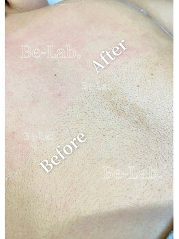 ビーラボ(Be-Lab.)/ボディのワックス脱毛も人気♪