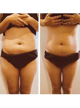 リム ビューティー(RYM BEAUTY)/最新超音波でお腹ケア