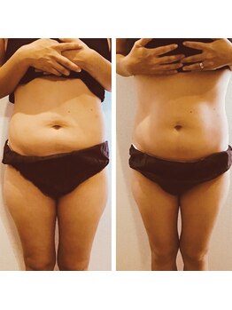 リム ビューティー(RYM BEAUTY)/最新超音波でお腹ケア